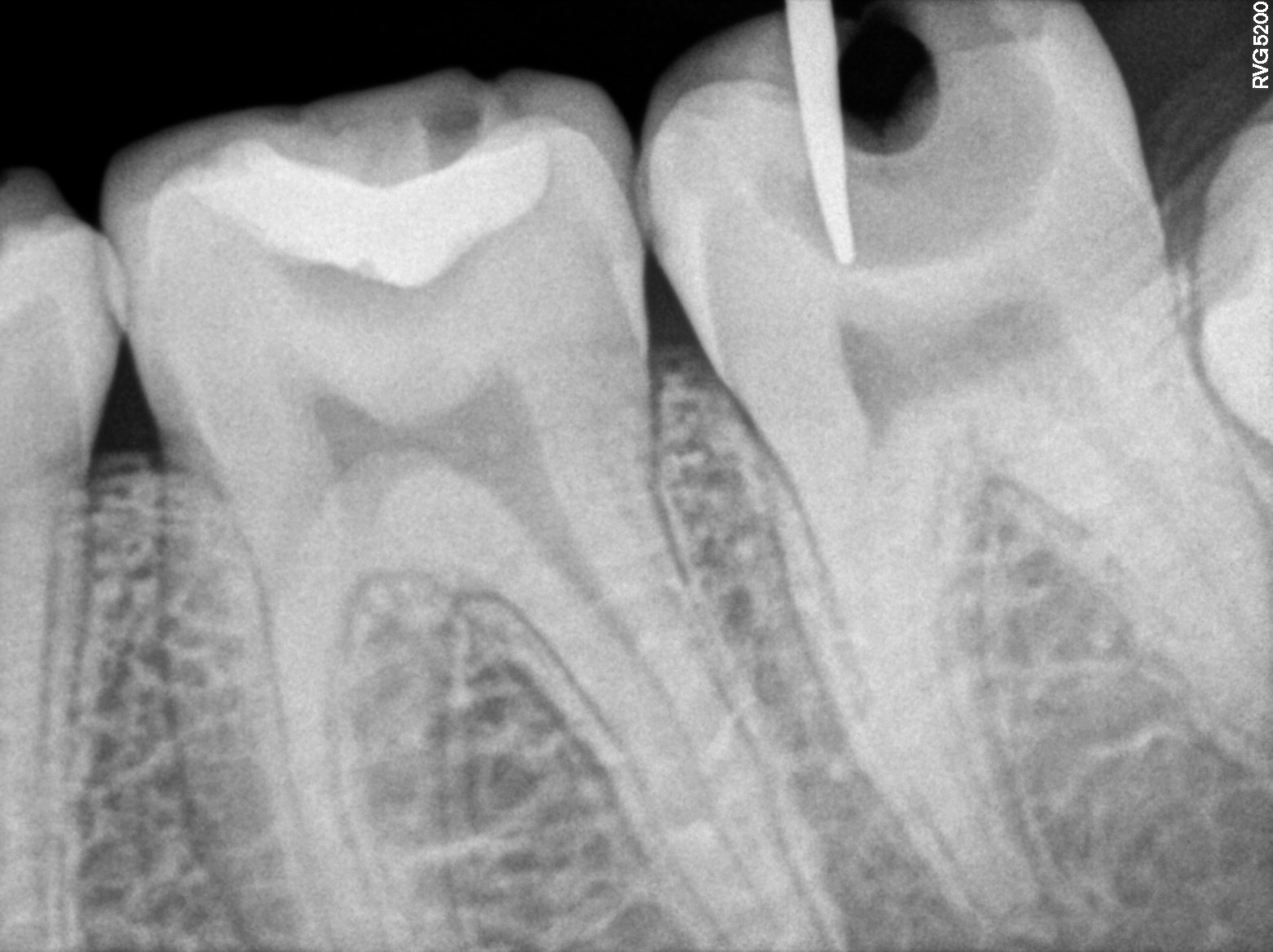 Dental X-ray